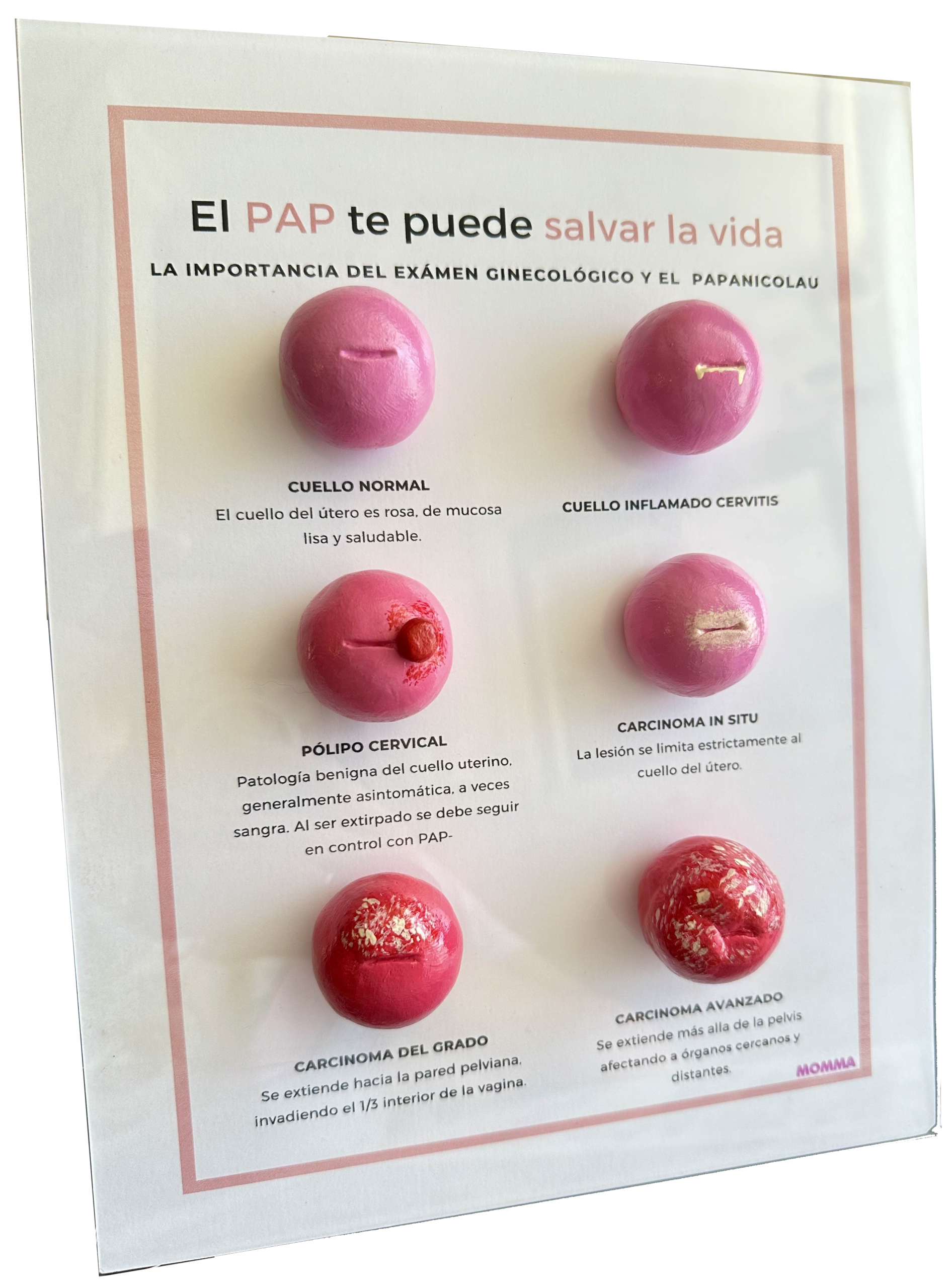 Modelo anatómico de cáncer cervicouterino en escala real