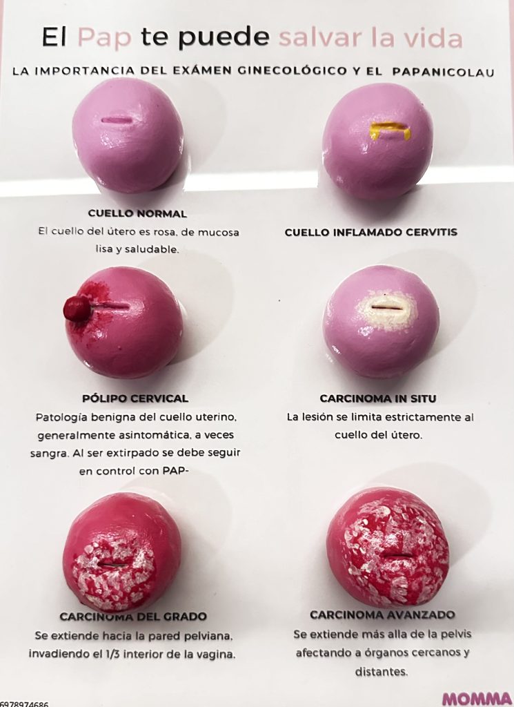 modelo educativo que muestra distintas lesiones del cuello uterino asociadas al cáncer cervicouterino, incluyendo displasias, neoplasias y etapas avanzadas. Ideal para enseñanza médica, prevención y educación sobre el VPH y el cáncer cervical.